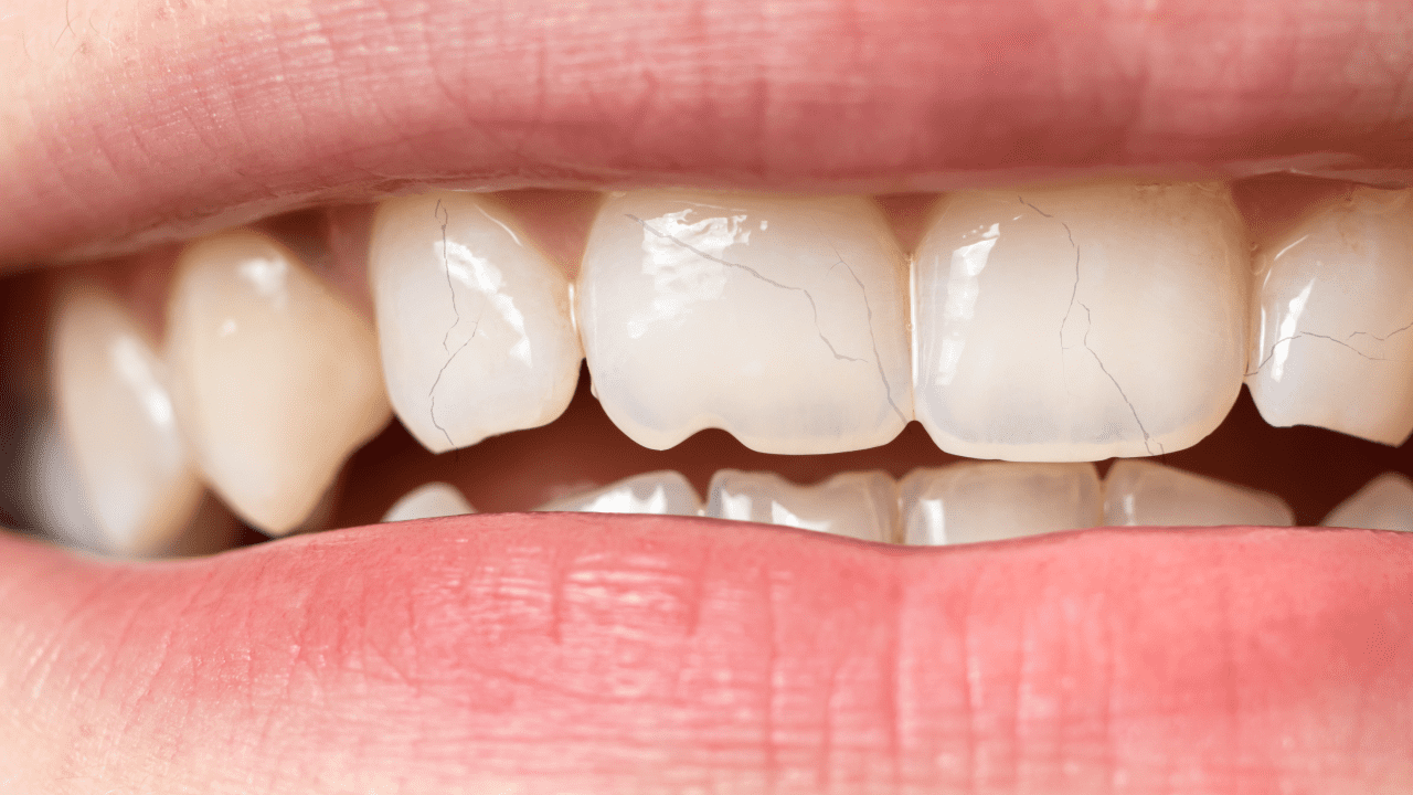 Grinding teeth can cause 'craze lines' and more